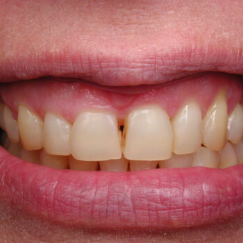 پوسیدگی بین دندانی