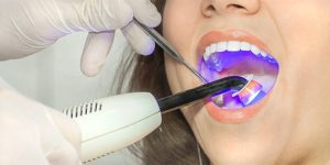 انواع لیزر های دندانپزشکی