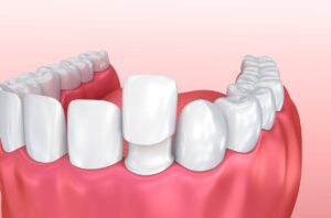 مراحل درمان ریشه دندان جلویی