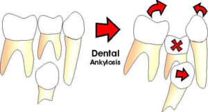 علائم انکیلوز دندان
