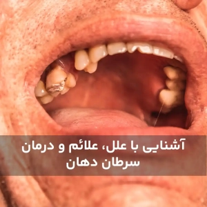 آشنایی با علل، علائم و درمان سرطان دهان