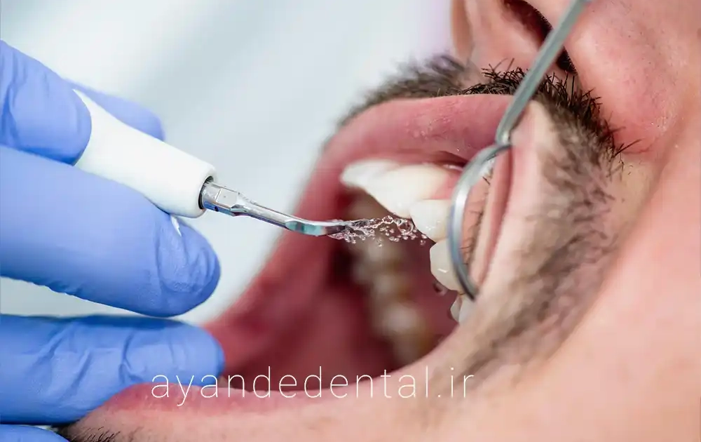 چه مدت یکبار باید دندان‌ هایمان را جرم‌ گیری کنیم؟