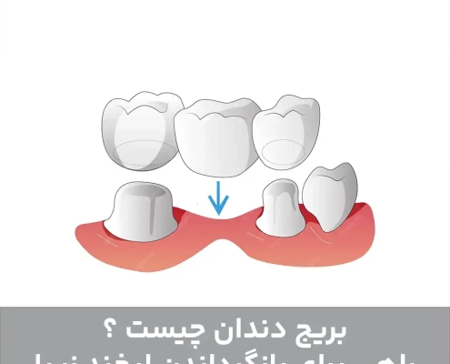 بریج دندان چیست ؟ راهی برای بازگرداندن لبخند زیبا