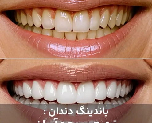 باندینگ دندان : ترمیم سریع و آسان