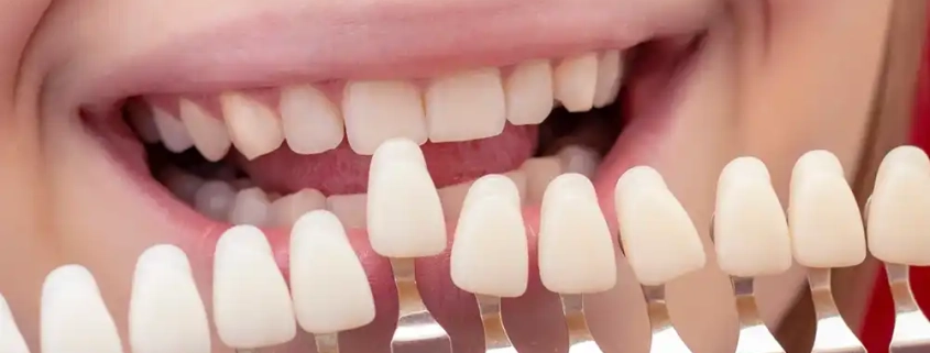 همه چیز درباره کامپوزیت دندان : راهنمای جامع