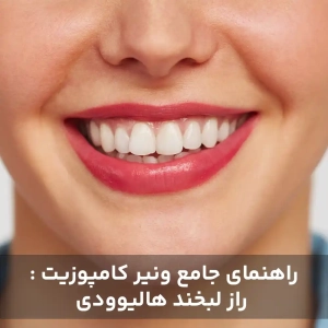 راهنمای جامع ونیر کامپوزیت : راز لبخند هالیوودی