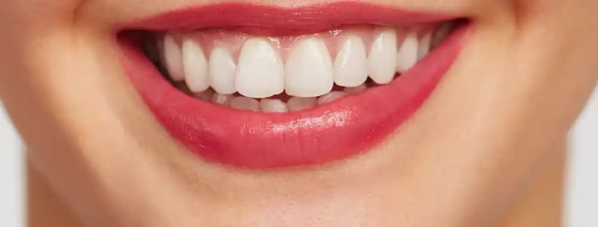 راهنمای جامع ونیر کامپوزیت : راز لبخند هالیوودی