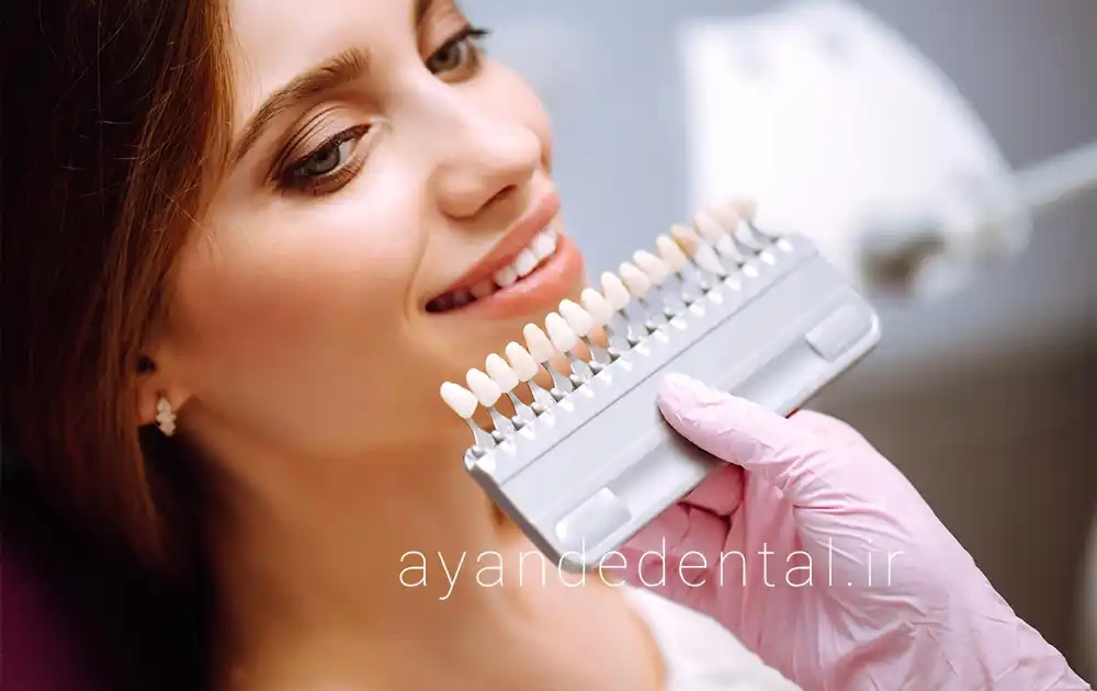 انواع ونیر دندان: کامپوزیت یا پرسلن