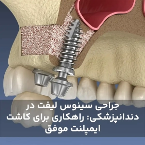 جراحی سینوس لیفت در دندانپزشکی: راهکاری برای کاشت ایمپلنت موفق