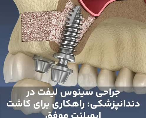 جراحی سینوس لیفت در دندانپزشکی: راهکاری برای کاشت ایمپلنت موفق