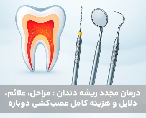 درمان مجدد ریشه دندان : مراحل، علائم، دلایل و هزینه کامل عصب‌کشی دوباره