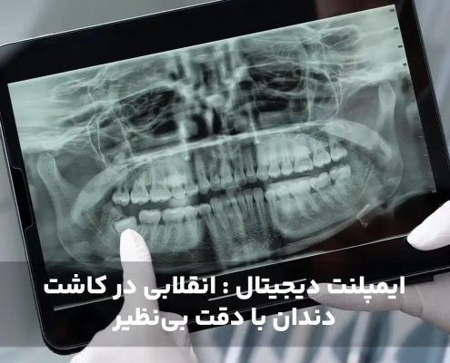 ایمپلنت دیجیتال : انقلابی در کاشت دندان با دقت بی‌نظیر