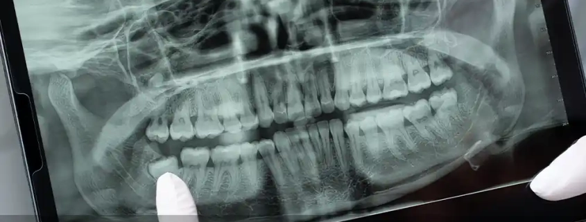 ایمپلنت دیجیتال : انقلابی در کاشت دندان با دقت بی‌نظیر