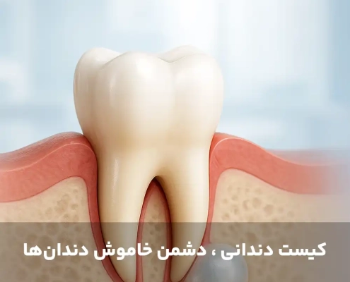 کیست دندانی ، دشمن خاموش دندان‌ها