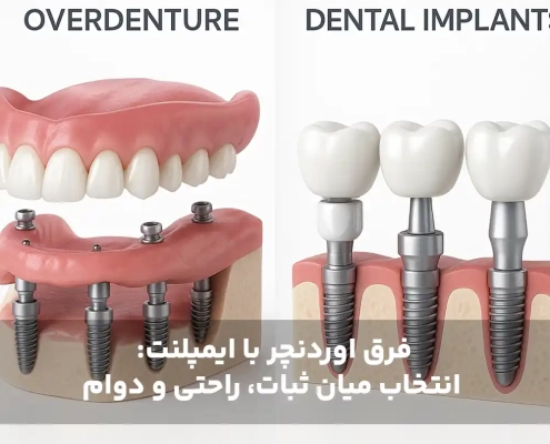 فرق اوردنچر با ایمپلنت: انتخاب میان ثبات، راحتی و دوام