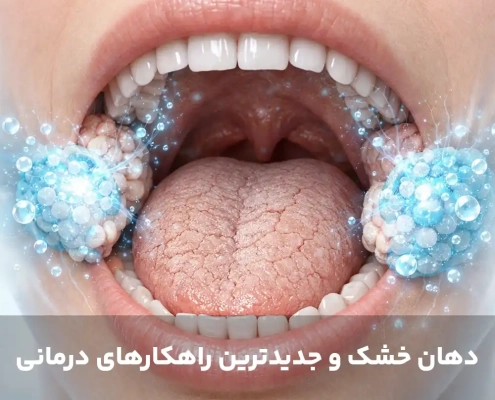 دهان خشک و جدیدترین راهکارهای درمانی