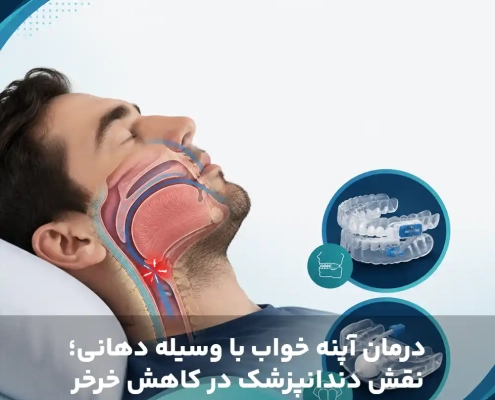 تصویر شاخص درمان آپنه خواب و وسایل داخل دهانی دندانپزشکی