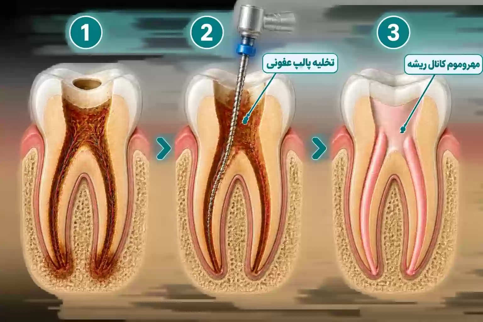  مراحل درمان ریشه دندان، تخلیه پالپ عفونی و پر کردن کانال‌های ریشه با گوتاپرکا
