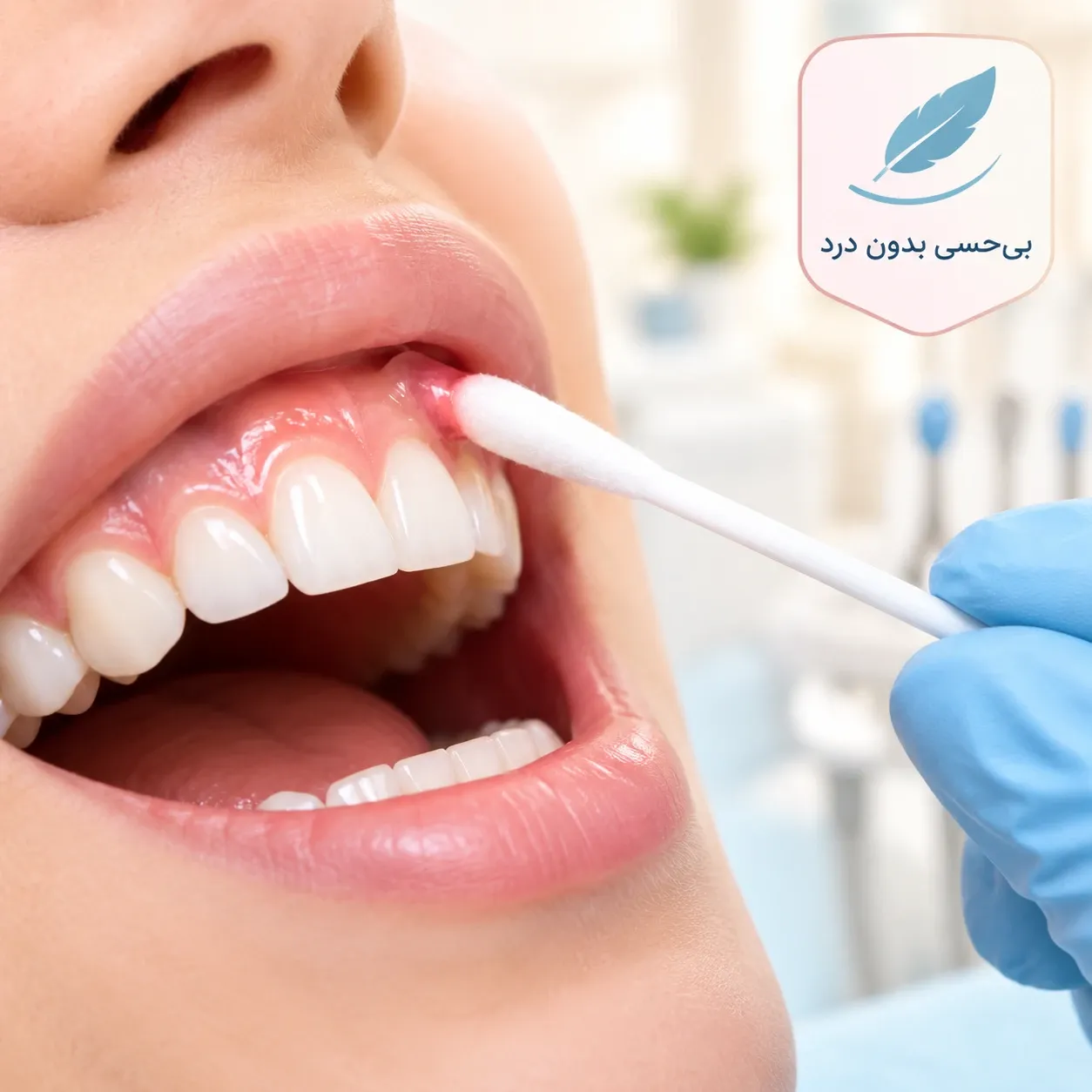 استفاده از ژل بی‌حسی موضعی بر روی لثه برای پیشگیری از احساس سوزن دندانپزشکی